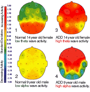 Comparison of Normal and ADD Boy and Girl Theta Wave Graph