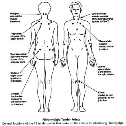 The location of the 18 Tender Points of Fibromyalgia