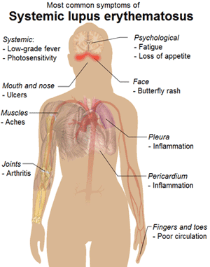 Symptoms of Lupus